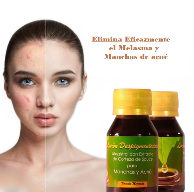 Despigmentador Cutáneo Para Manchas + Acetato Para El Acné