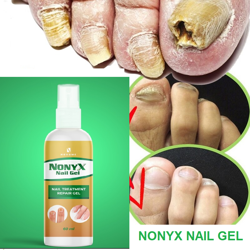 Poderoso tratamiento para combatir los hongos de las uñas NONYX NAIL GEL ⭐⭐⭐⭐⭐