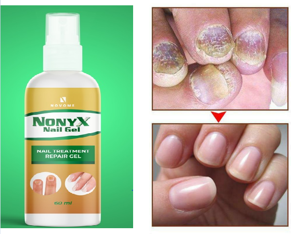 Poderoso tratamiento para combatir los hongos de las uñas NONYX NAIL GEL ⭐⭐⭐⭐⭐
